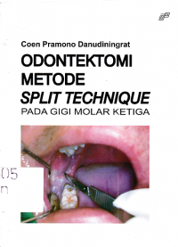 Odentektomi Metode Split Technique pada Gigi Molar Ketiga